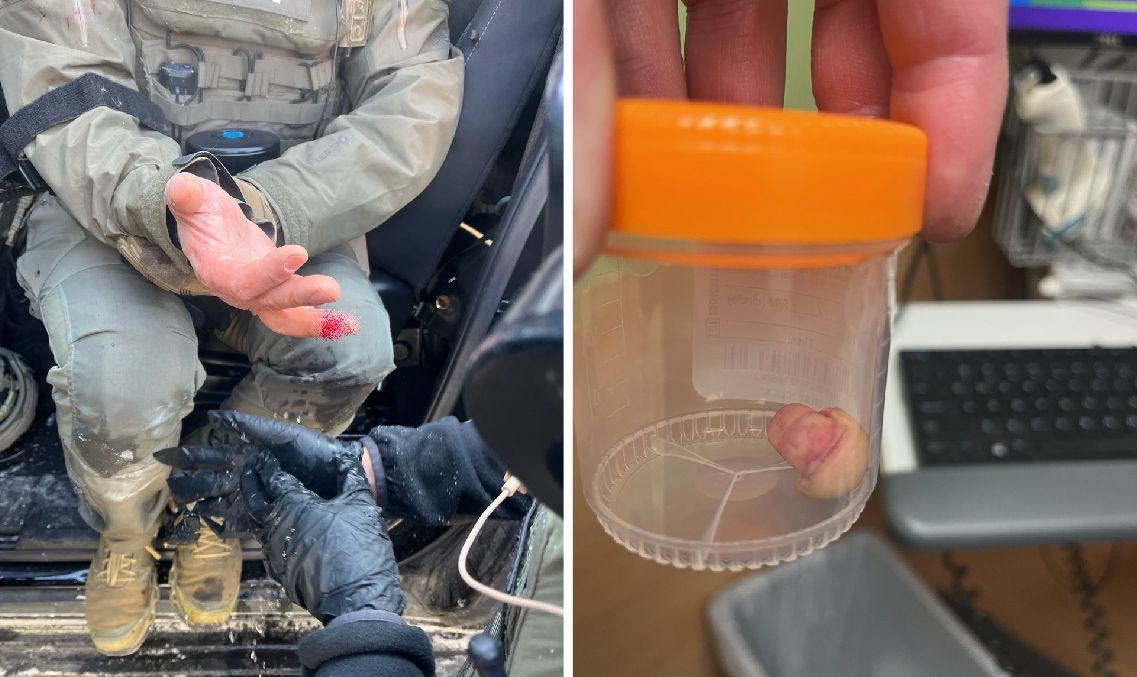 odgryzł palec funkcjonariuszowi federalnemu