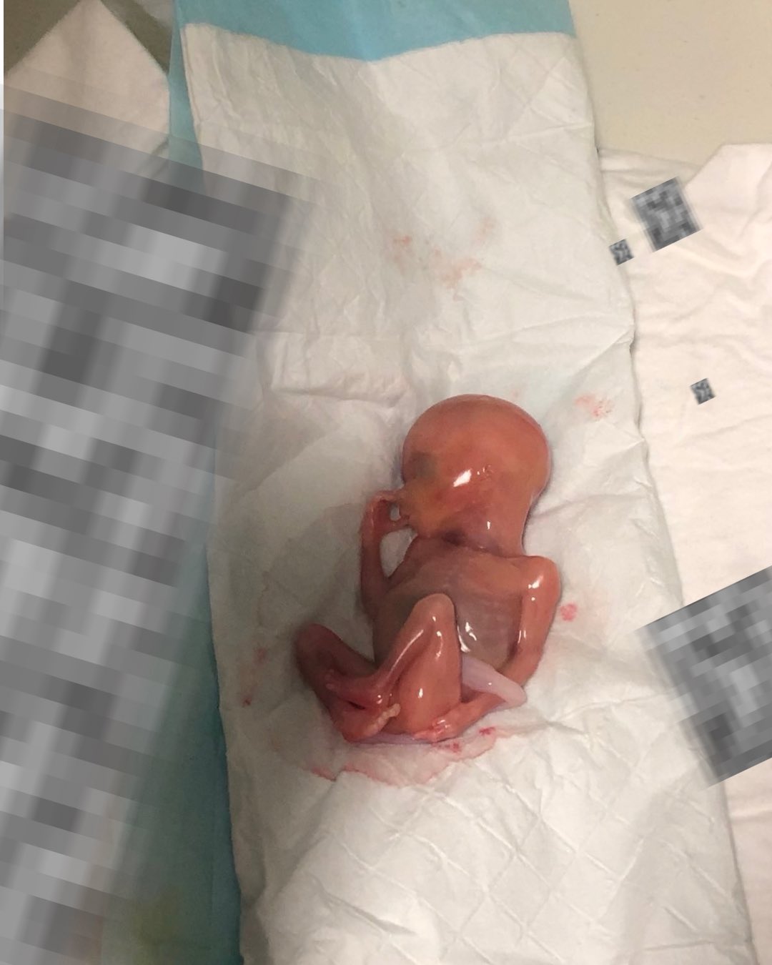 dziecko, które przeżyło aborcję