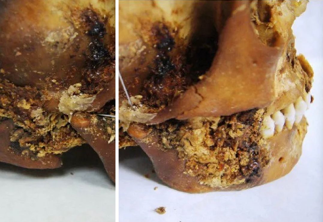 operacja szczęki 2500 lat temu