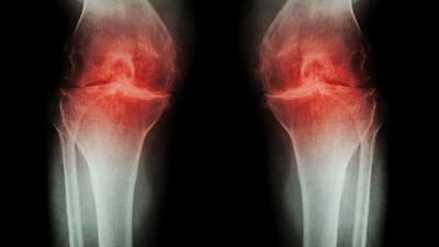 osteoartrozy