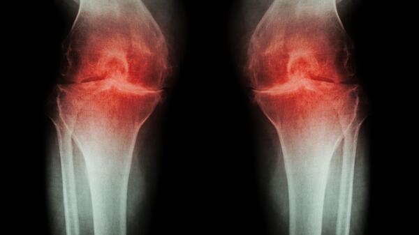 osteoartrozy