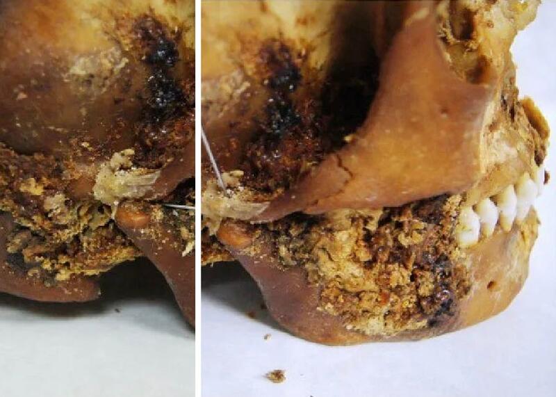 operacja szczęki 2500 lat temu